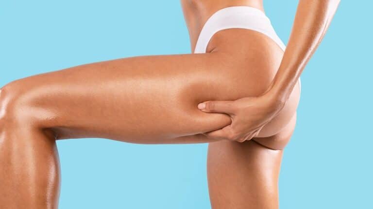 What You Need to Know About Cellulite