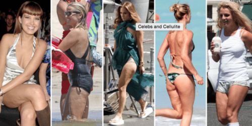 Cellulite Pacific Center for Plastic Surgery Newport Beach