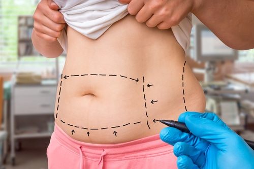 Tummy Tuck Newport Beach