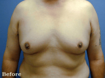 Gynecomastia impacts boys’ self-esteem and emotional health