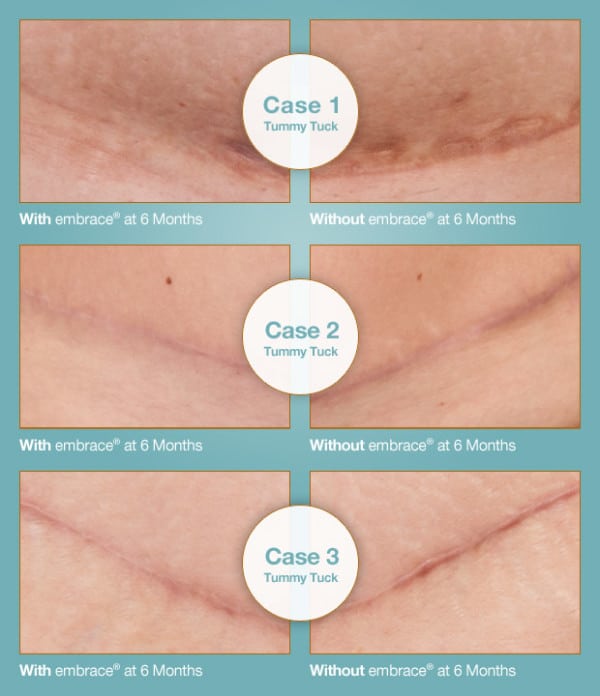 Introducing Embrace® Advanced Scar Therapy for Post-Surgical Scars