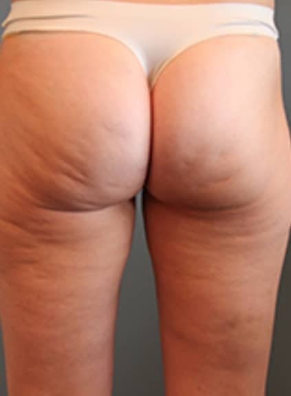 Cellulite Reduction