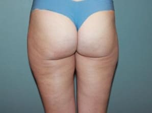 Cellfina Cellulite Reduction Before & After Newport Beach