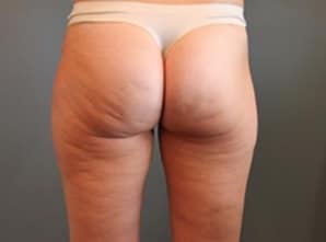 Cellfina Cellulite Reduction Before & After Newport Beach