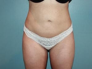 Liposuction Newport Beach & OC