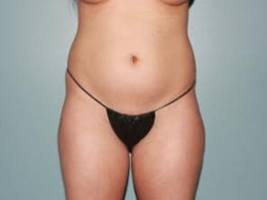 Liposuction Newport Beach & OC