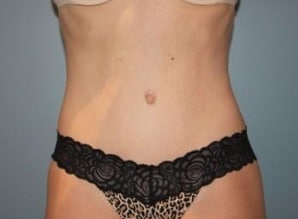 Tummy Tuck Before & After Newport Beach