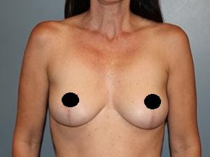 Breast Lift Newport Beach, Orange County