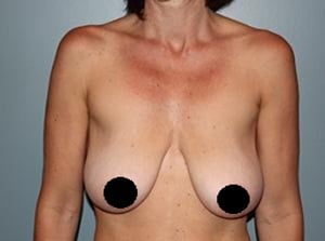 Breast Lift Newport Beach, Orange County