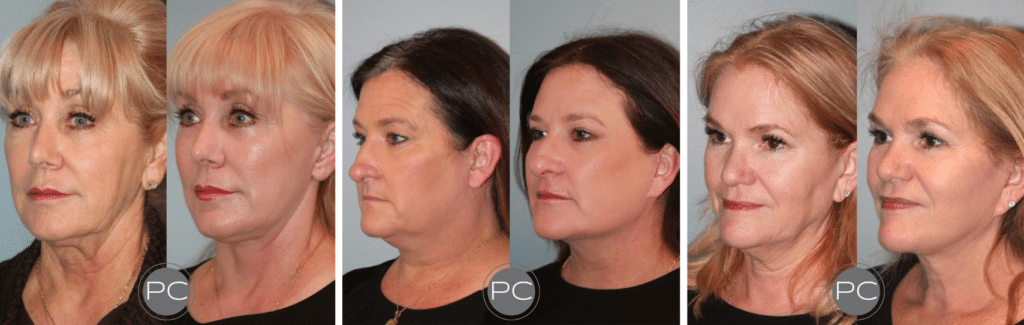 Facelift Before and After